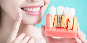 Top 7 Reasons Which Make Dental Implants the Best Option
