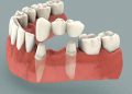 Dental Implant – The Best Option as Teeth Replacement
