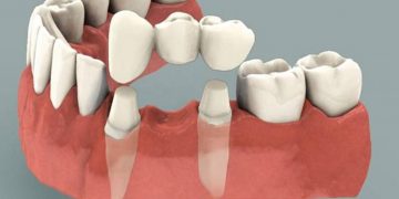 Dental Implant – The Best Option as Teeth Replacement