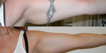 Learn The Basics About Tattoo Removal