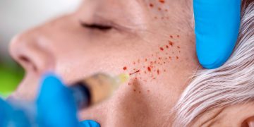 All About PRP Facials: Things Worth Knowing!