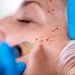 All About PRP Facials: Things Worth Knowing!