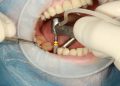 Knowing About Dental Implants: Replace Your Dentures!