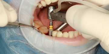 Knowing About Dental Implants: Replace Your Dentures!