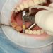 Knowing About Dental Implants: Replace Your Dentures!