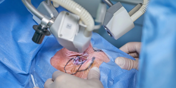 When should you Undergo Cataract Surgery