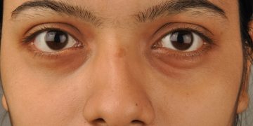 How is the Dark Eye Circle Removal Treatment Helpful