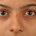 How is the Dark Eye Circle Removal Treatment Helpful