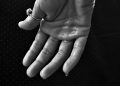 How Does Hyperhidrosis Affect Your Everyday Life?