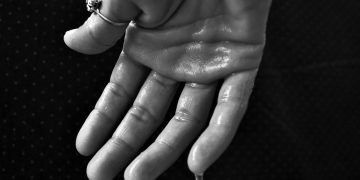 How Does Hyperhidrosis Affect Your Everyday Life?