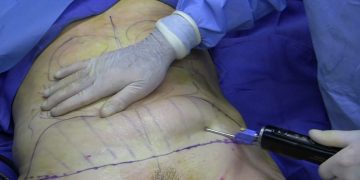 Liposuction Procedure In Nashville, TN For Better Look