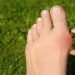 Few Advantages of Choosing Bunion