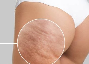 Cellulite Treatment: What You Need to Know