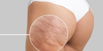 Cellulite Treatment: What You Need to Know