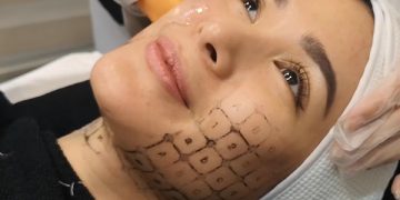 How Can You Make The Most Benefit Out Of This Thermage Treatment?