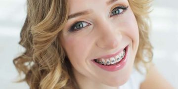 Why is it Never Too Late for Adult Braces? 