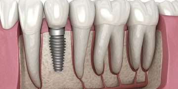 Does Osteoporosis Affect Dental Implants?