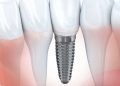 Who Should Consider Getting Dental Implants in Chelsea, NYC?