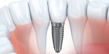 Who Should Consider Getting Dental Implants in Chelsea, NYC?