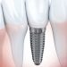 Who Should Consider Getting Dental Implants in Chelsea, NYC?