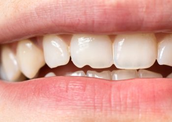 What Are the Main Types of Dental Restorations for Damaged Teeth