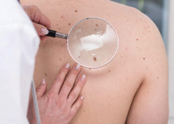 How to Spot Early Symptoms of Skin Cancer