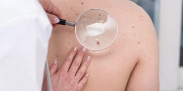 How to Spot Early Symptoms of Skin Cancer